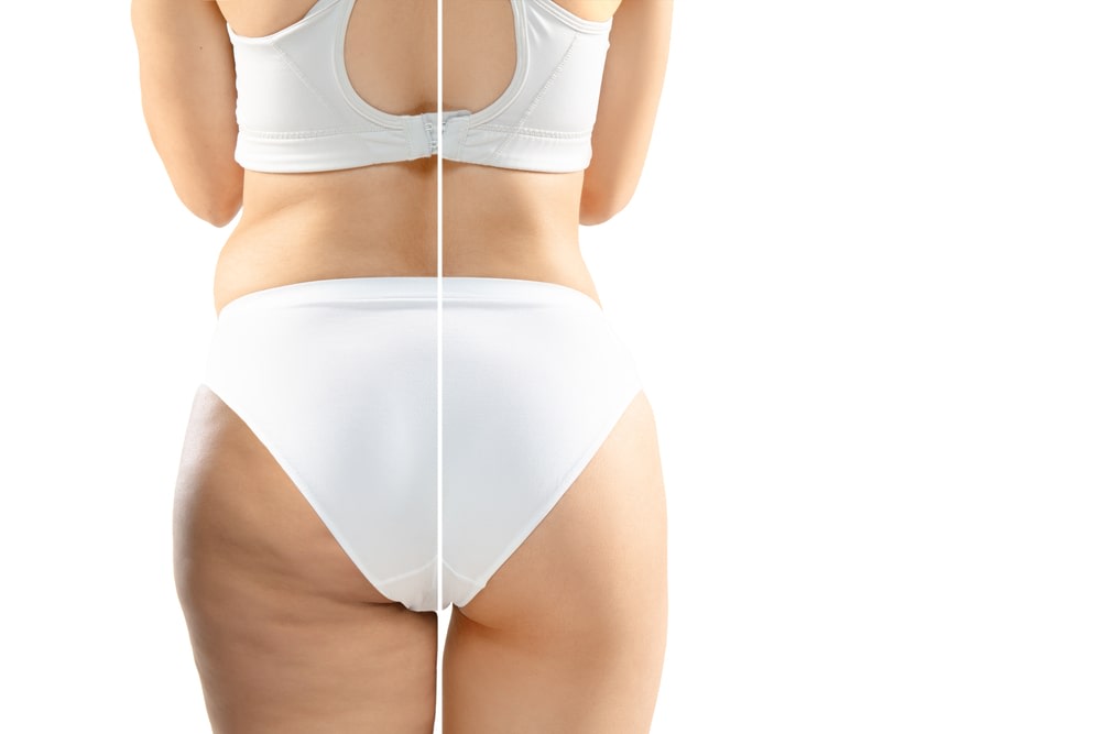 La aparición de la celulitis en las piernas puede darse por factores genéticos. Es necesario cuidar la alimentación mucho más así como controlar el peso.